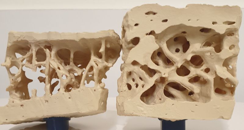 osteoporosi covid19
