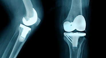 knee arthroplasty 2 600
