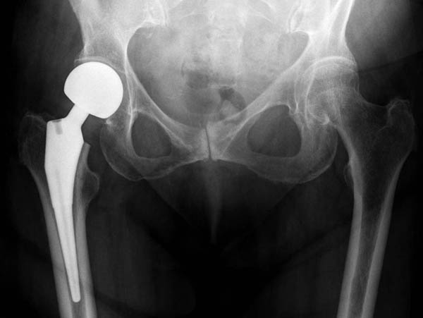 partial hip replacement 600