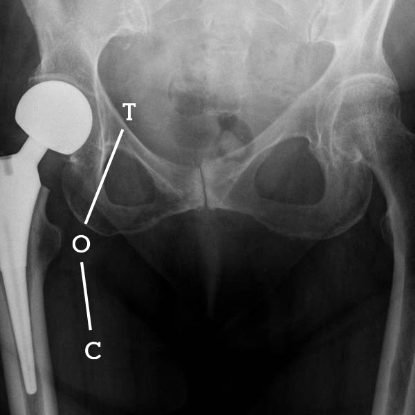 partial hip replacement archiki