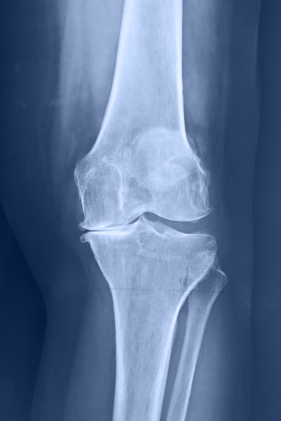 οστεοαρθρίτιδα γόνατος 1
